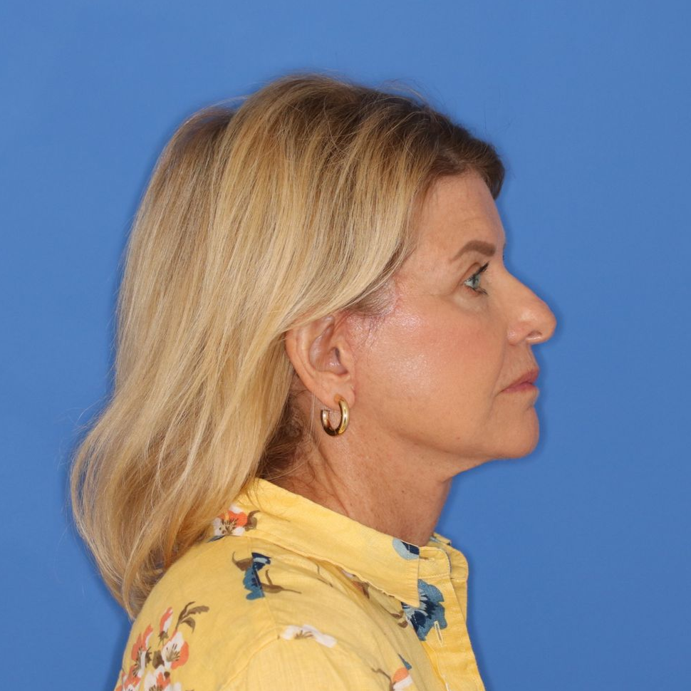 71 year old female after receiving a blepharoplasty