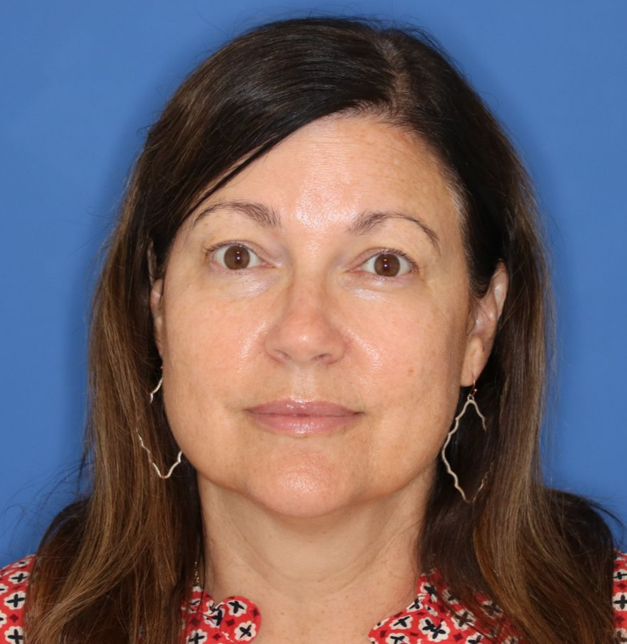 A 51 year old female before photo, who underwent bilateral upper blepharoplasty under local anesthesia in office. 