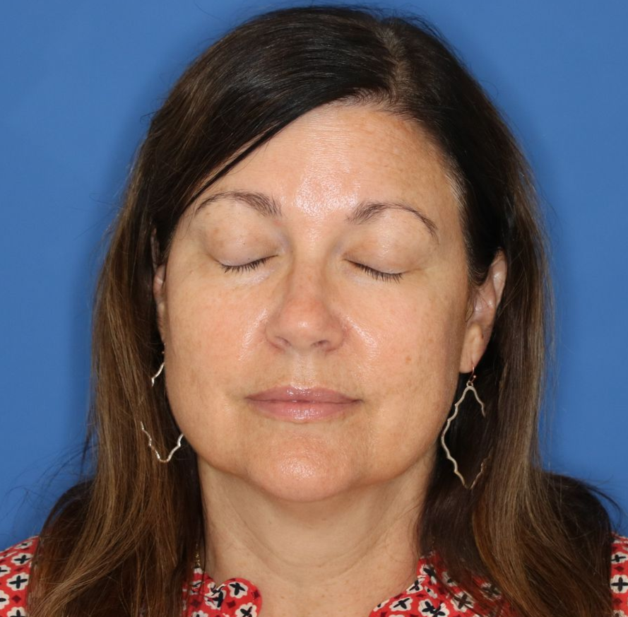 An eyes closed, before photo of a 51 year old female who underwent bilateral upper blepharoplasty.