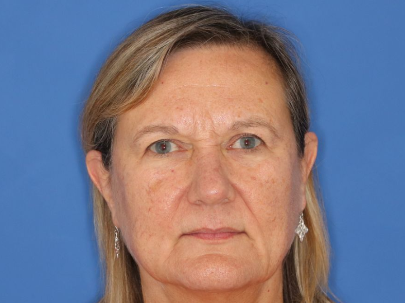 Close up of woman's face before CO2 laser treatment at Carson Williams MD Facial Plastic Surgery