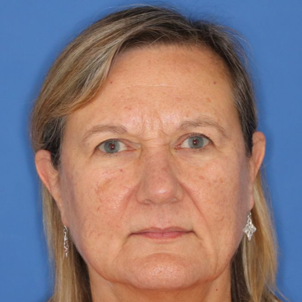 Close up of woman's face before CO2 laser treatment at Carson Williams MD Facial Plastic Surgery