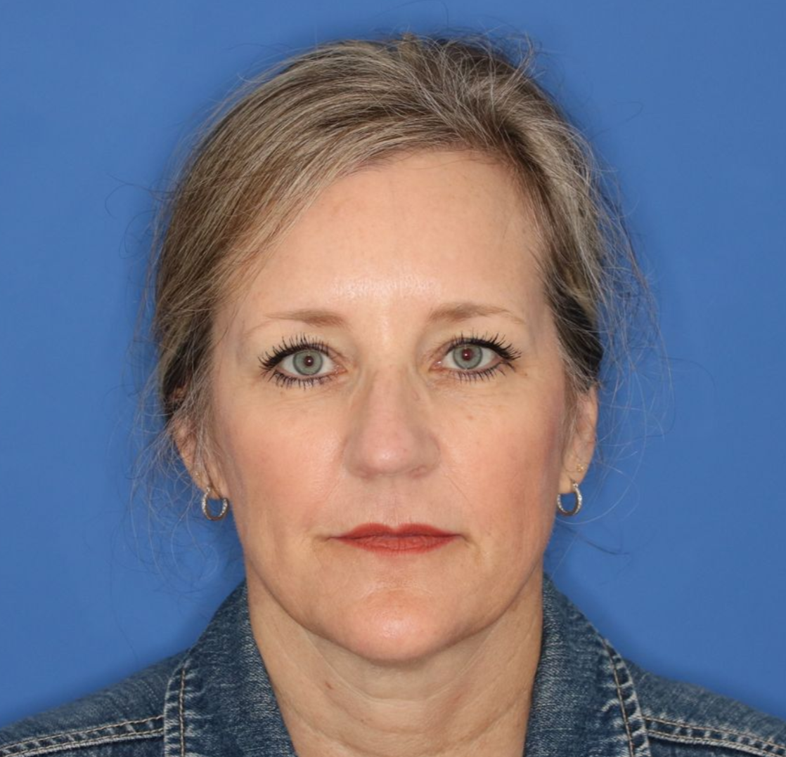 Before photos of a 52 year old female who underwent bilateral upper blepharoplasty under local anesthesia in office.