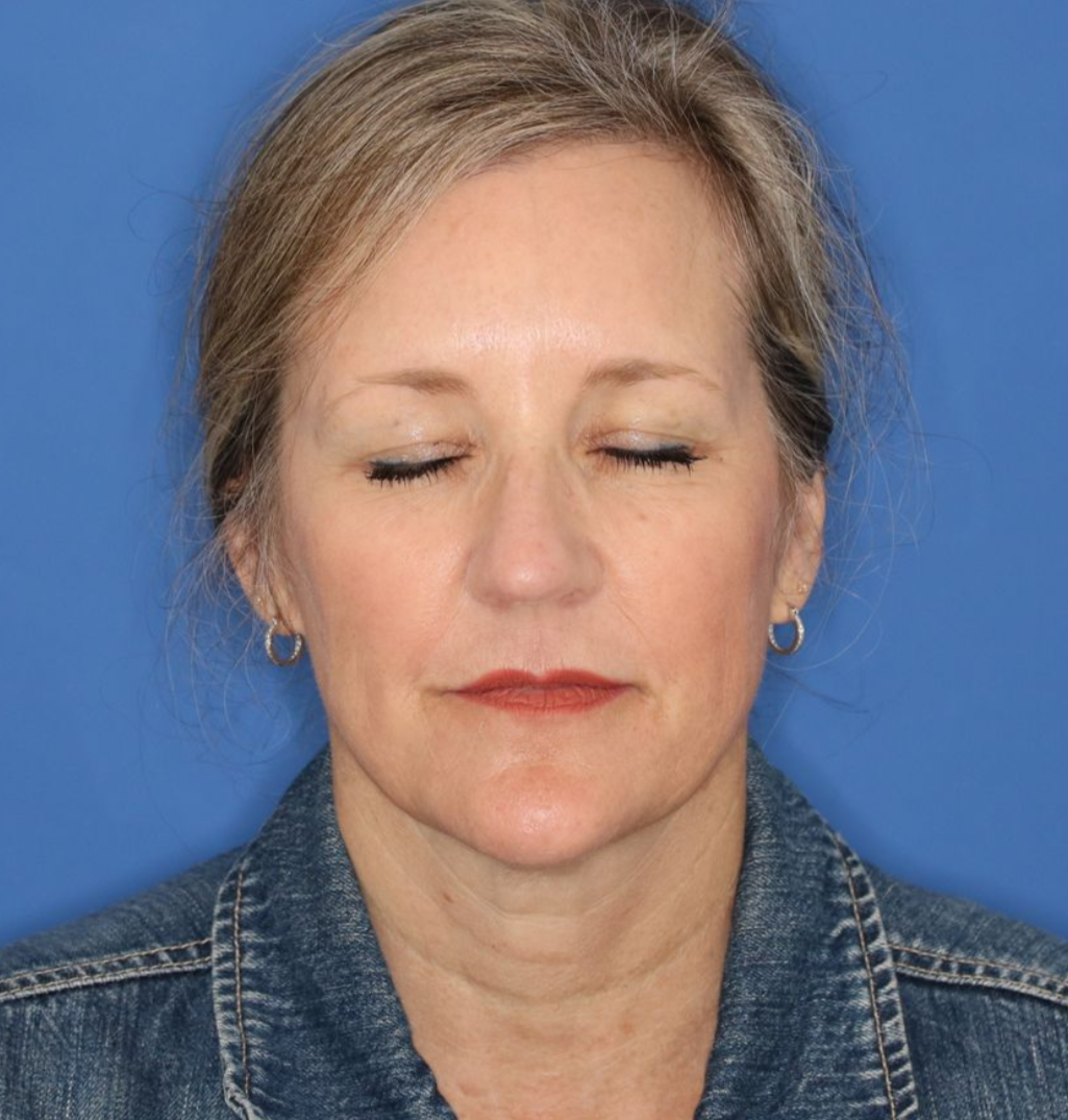 Eyes closed before photos of a 52 year old female who underwent bilateral upper blepharoplasty.
