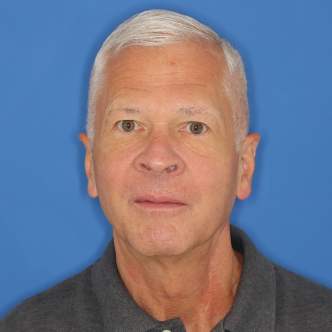 63 year old male who underwent bilateral upper blepharoplasty under local anesthesia in office. 