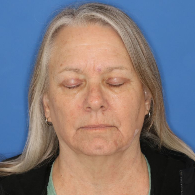 Eyes closed after photo of a 68 year old female posing for a photo who underwent bilateral upper blepharoplasty.