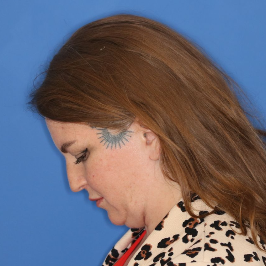 A female patient facing to the left for a before photo of a rhinoplasty