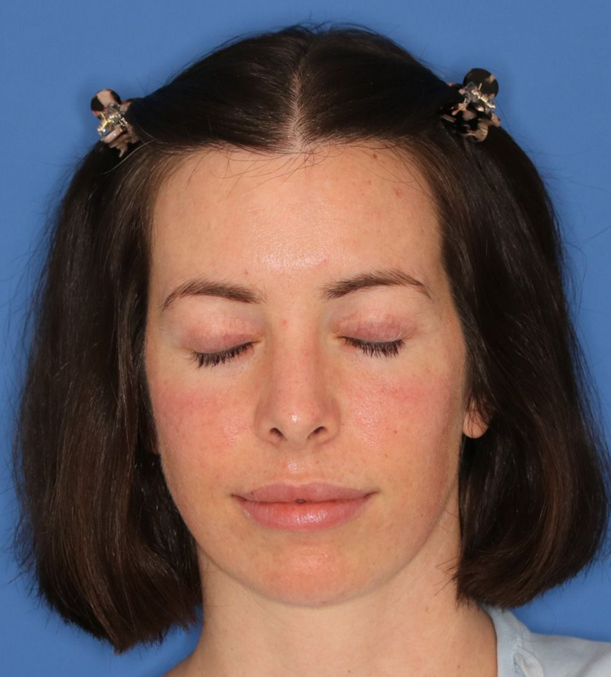 Female with eyes closed showing results of a healed blepharoplasty surgery