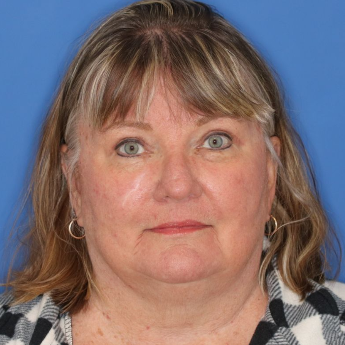 After photos of a 67 year old female who underwent bilateral upper blepharoplasty.