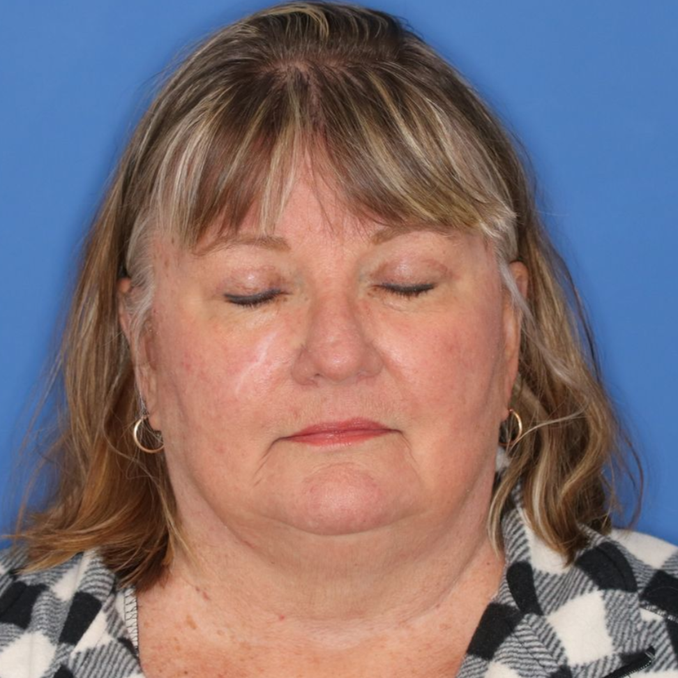 An eyes closed after photo of a 67 year old woman who had a blepharoplasty surgery