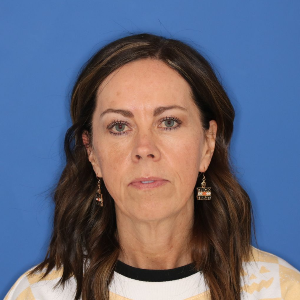 Woman poses in front of a blue background before receiving CO2 laser treatment