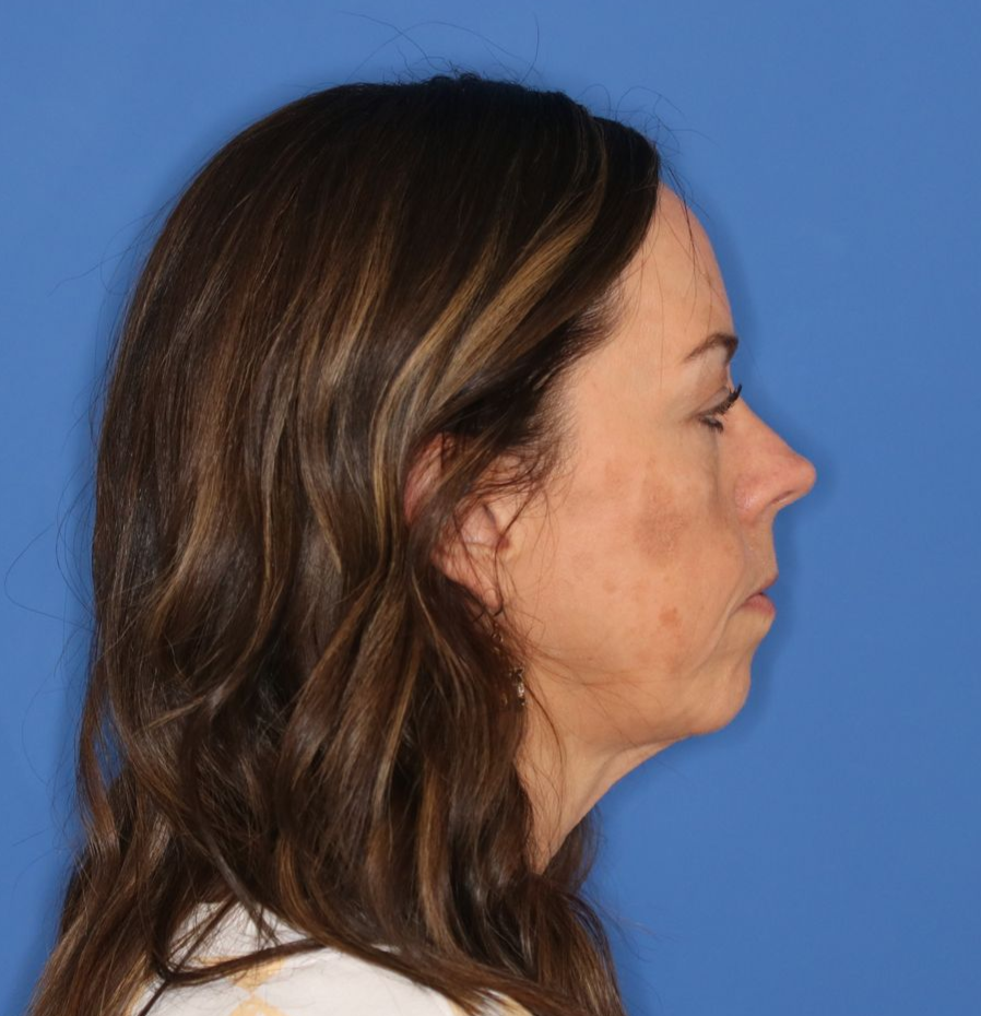 Woman facing to the right in front of a blue background before a facelift