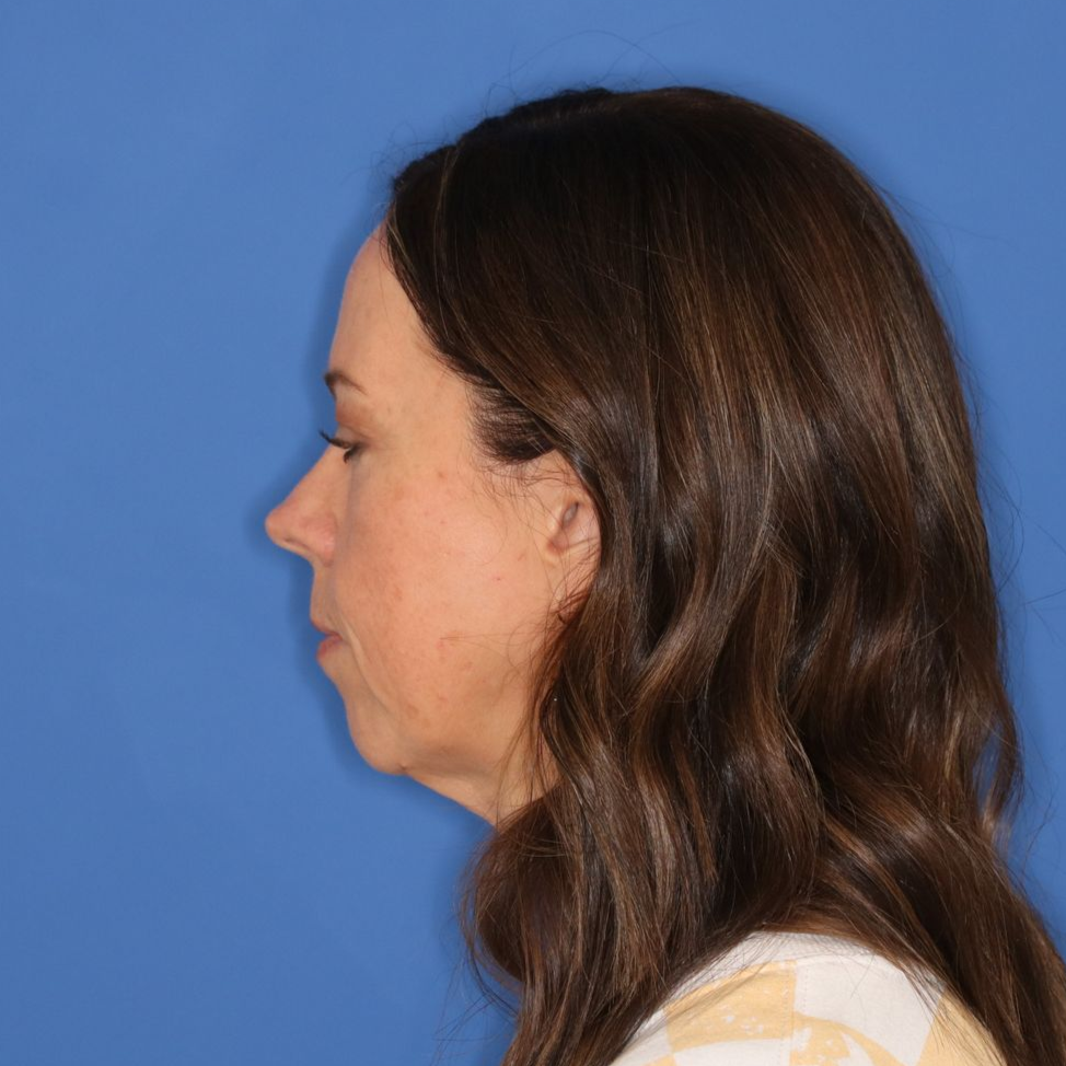 Woman facing to the left posing for a before facelift photo