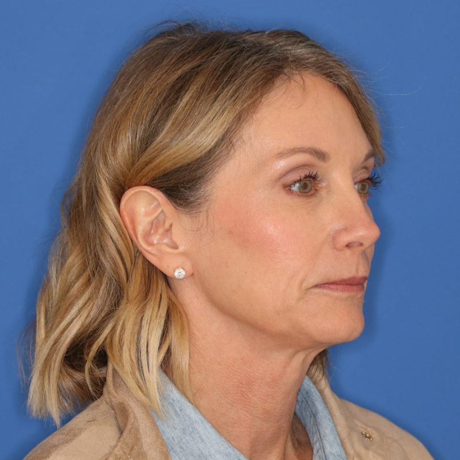 55 year old female before undergoing deep plane face and neck lift posing on a blue background