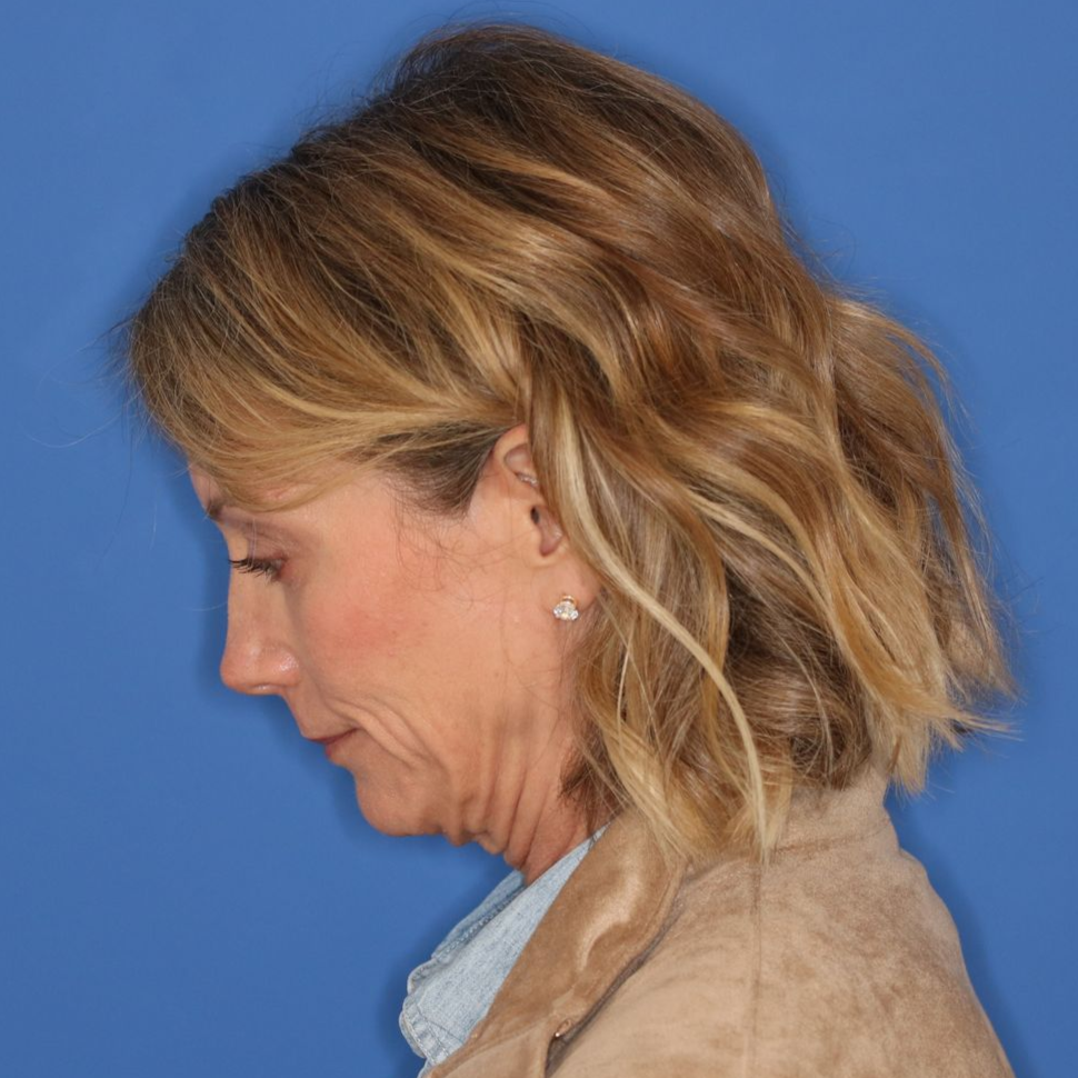 55 year old female underwent deep plane face and neck lift posing for an before photo on a blue background