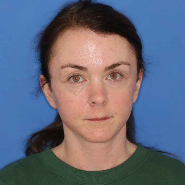 43 year old female underwent deep plane face and neck lift posing for an after photo