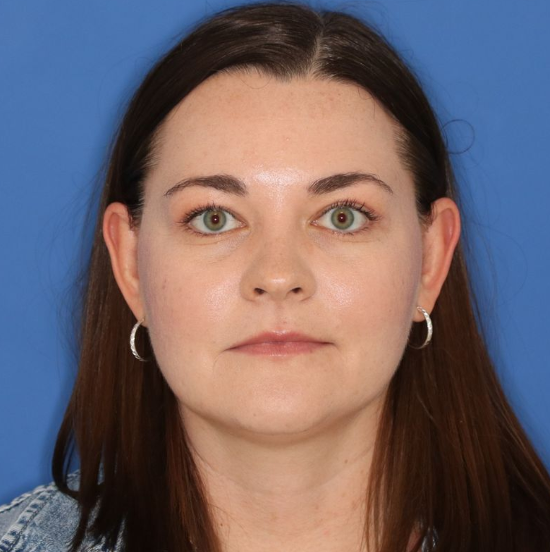 A 35 year old woman after a blepharoplasty surgery