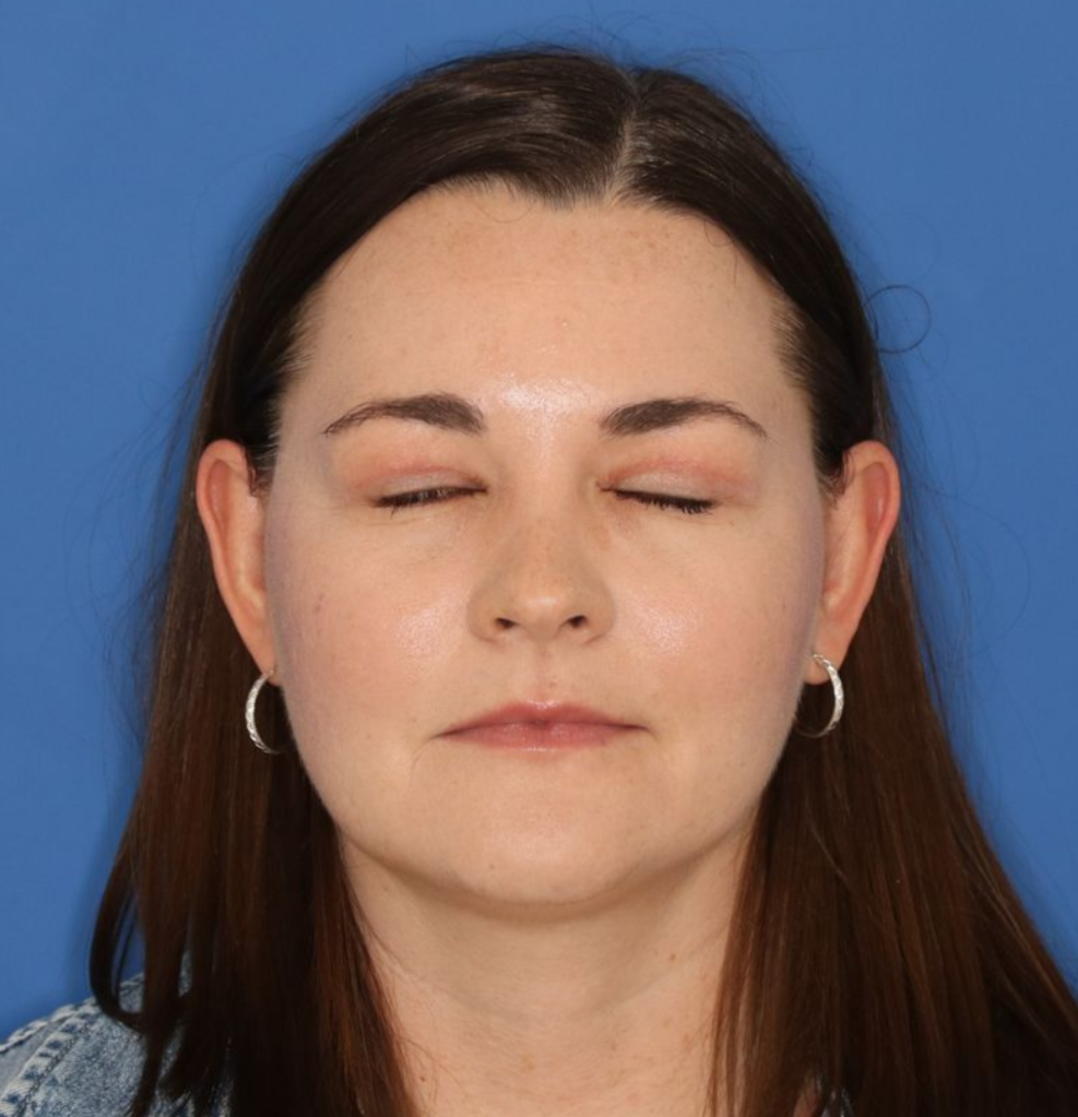 A closed eyed after photo of a blepharoplasty surgery on a 35 year old woman.