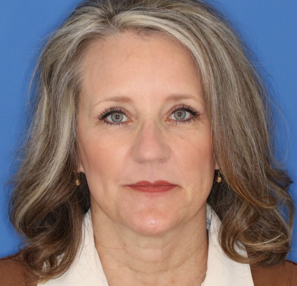 After results of a 52 year old female who underwent bilateral upper blepharoplasty under local anesthesia in office.