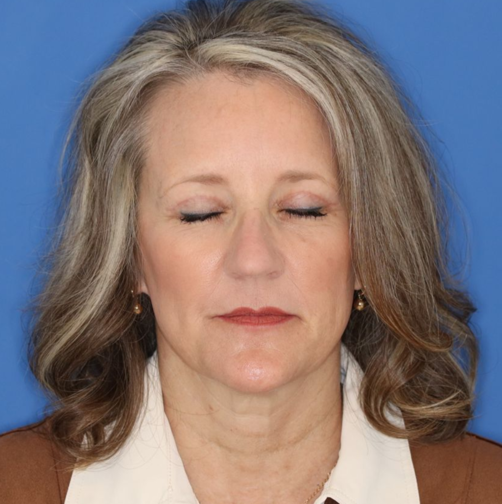 After photos of a 52 year old female who underwent bilateral upper blepharoplasty under local anesthesia in office. 