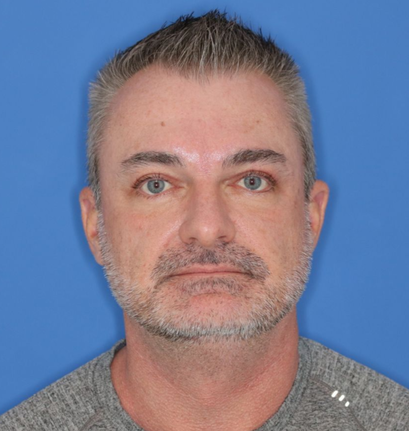 51 year old male posing for an after photo who underwent bilateral upper blepharoplasty under local anesthesia in office. 