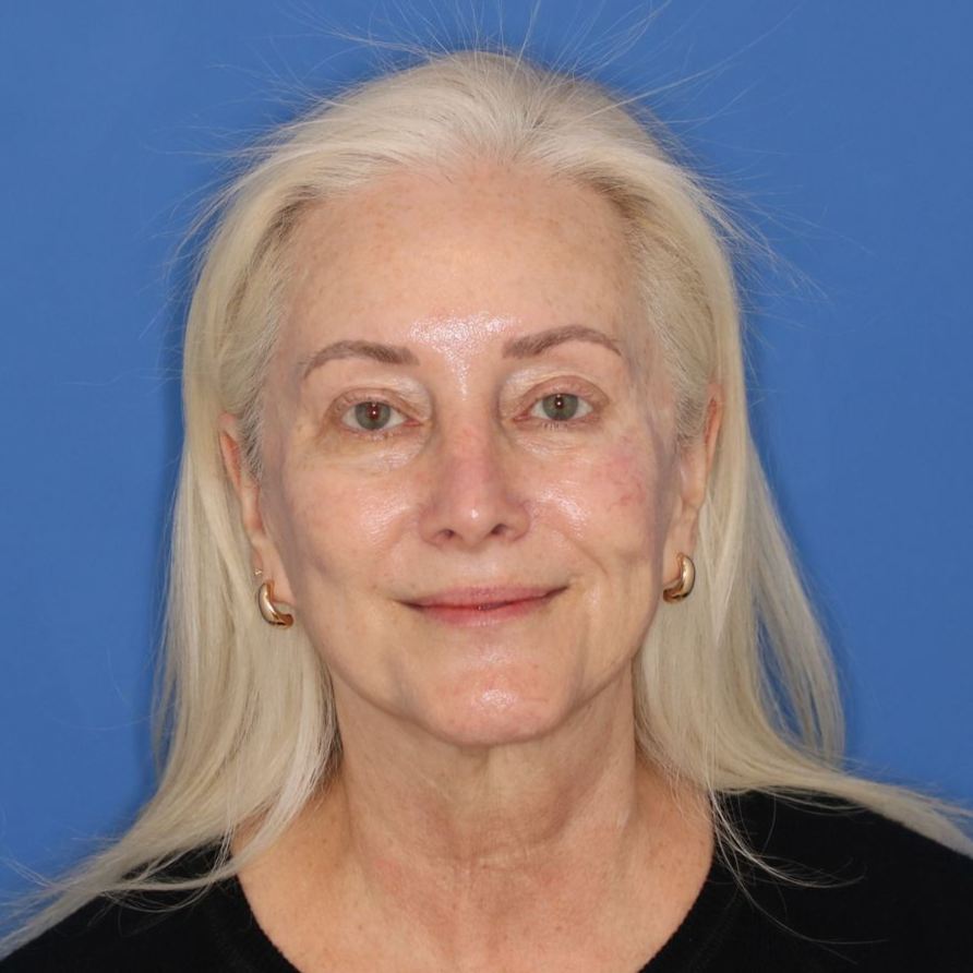Woman looking toward the camera posing for a before photo