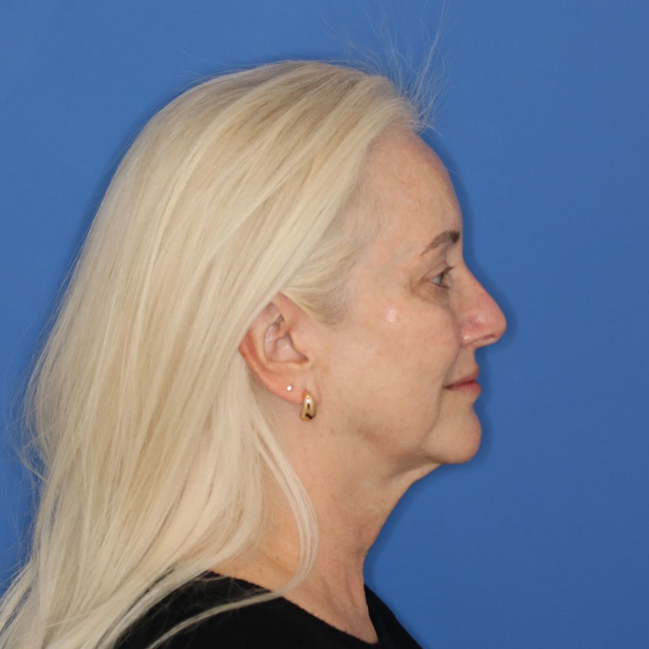 Woman facing to the right posing before receiving a facelift