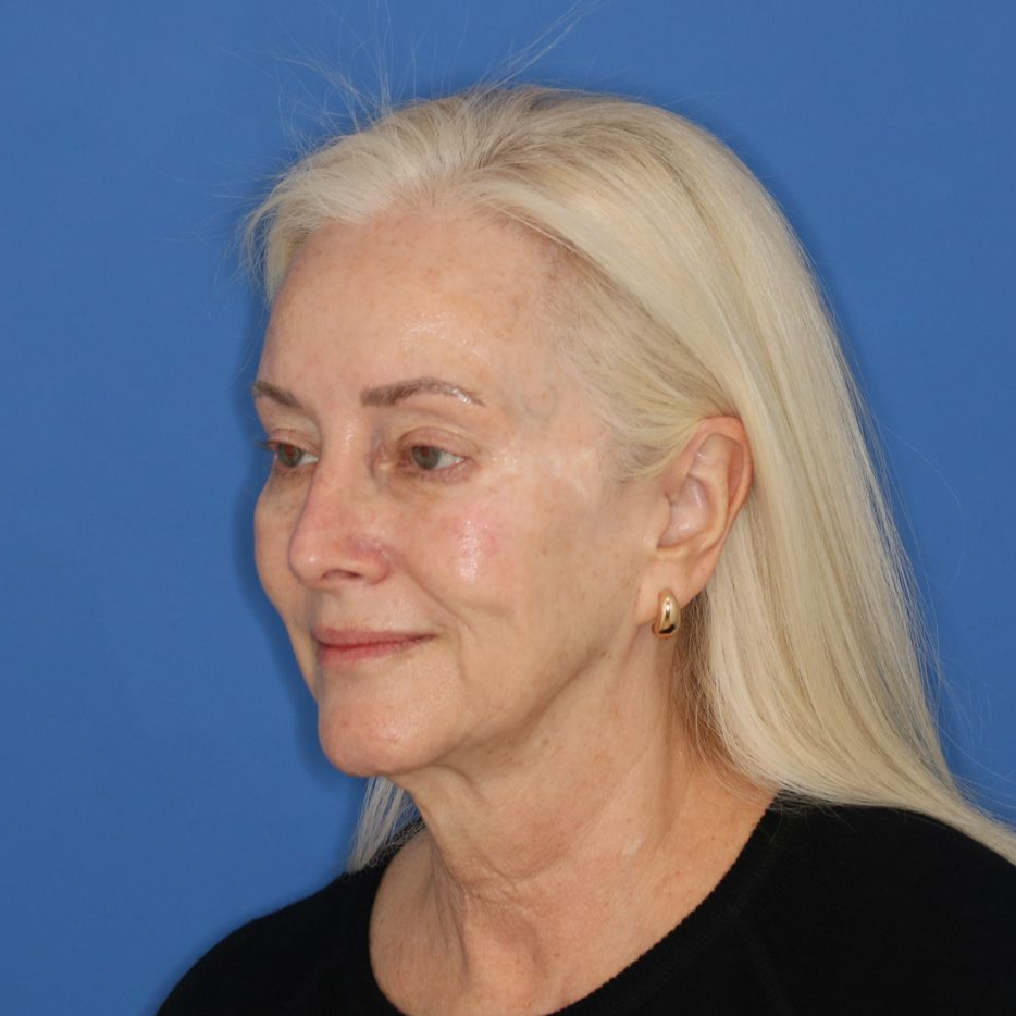Woman facing to the left posing for a before facelift picture