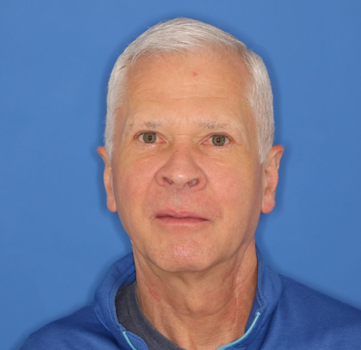 The results of a 63 year old male who underwent bilateral upper blepharoplasty under local anesthesia in office.