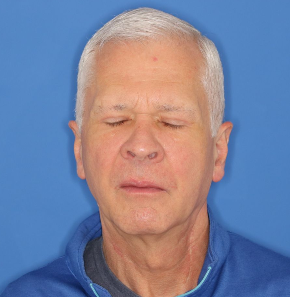 63 year old male patient after results of a blepharoplasty surgery