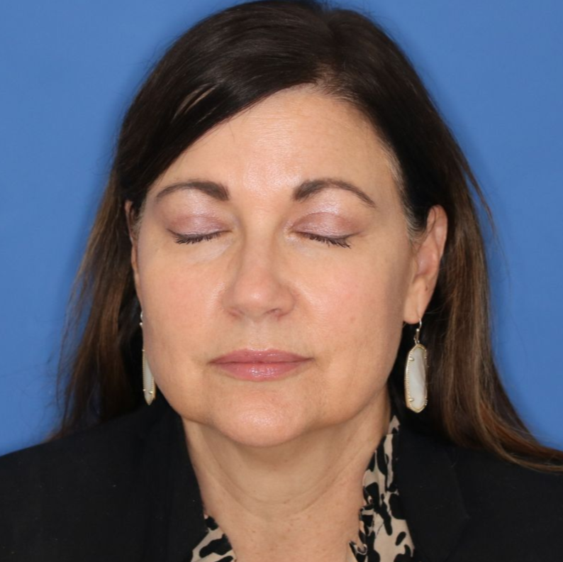 An eyes closed, after photo of an 51 year old female who underwent bilateral upper blepharoplasty.