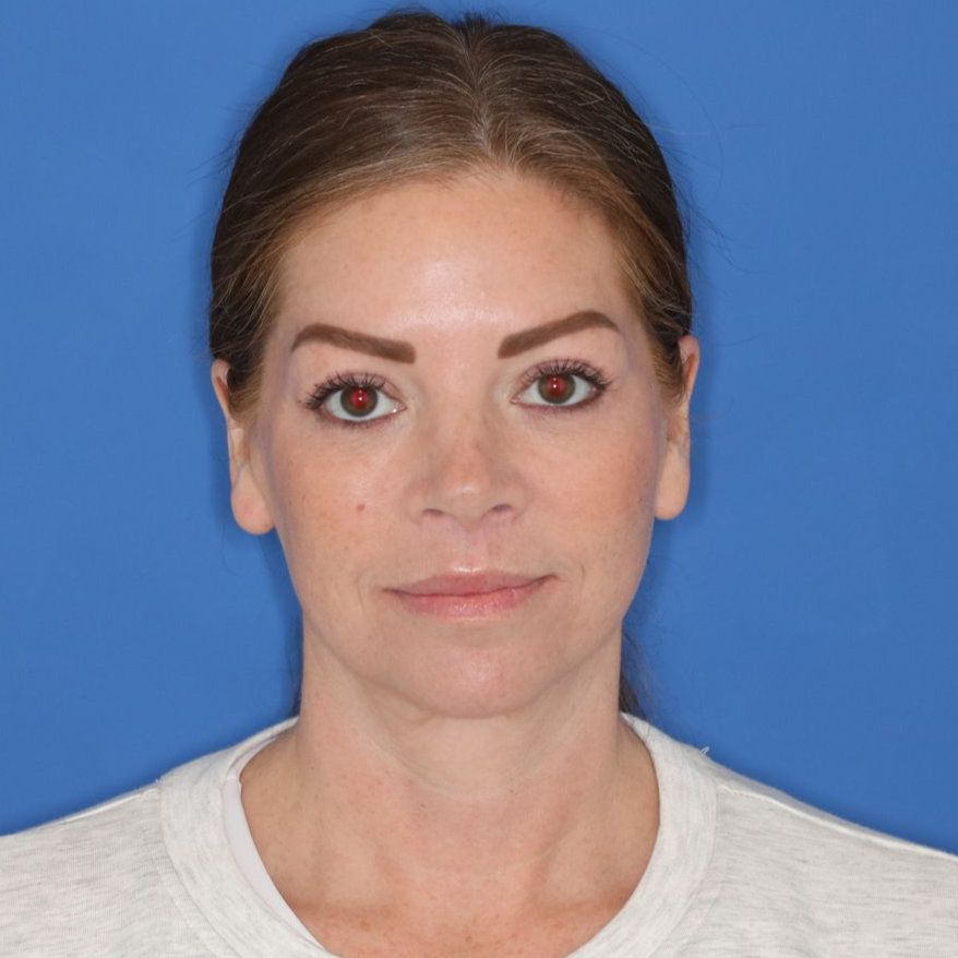 43 year old female underwent deep plane face and neck lift, upper lip lift, upper and lower blepharoplasty posing on a blue background