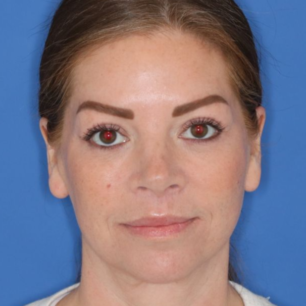 43 year old female underwent a lip lift posing for an after photo