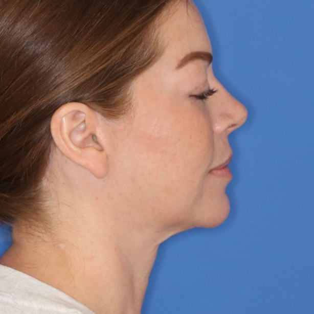 43 year old female in front of a blue background after surgery