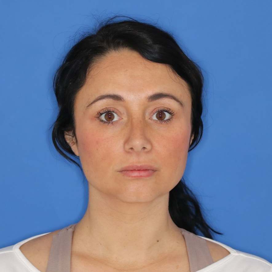 36 year old female posing on a blue background after receiving a rhinoplasty