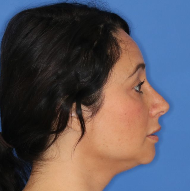 Side profile of a woman after receiving a rhinoplasty surgery