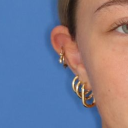 17 year old facing the camera before receiving an otoplasty