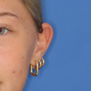 Close up of a 17 year old female's ear before otoplasty