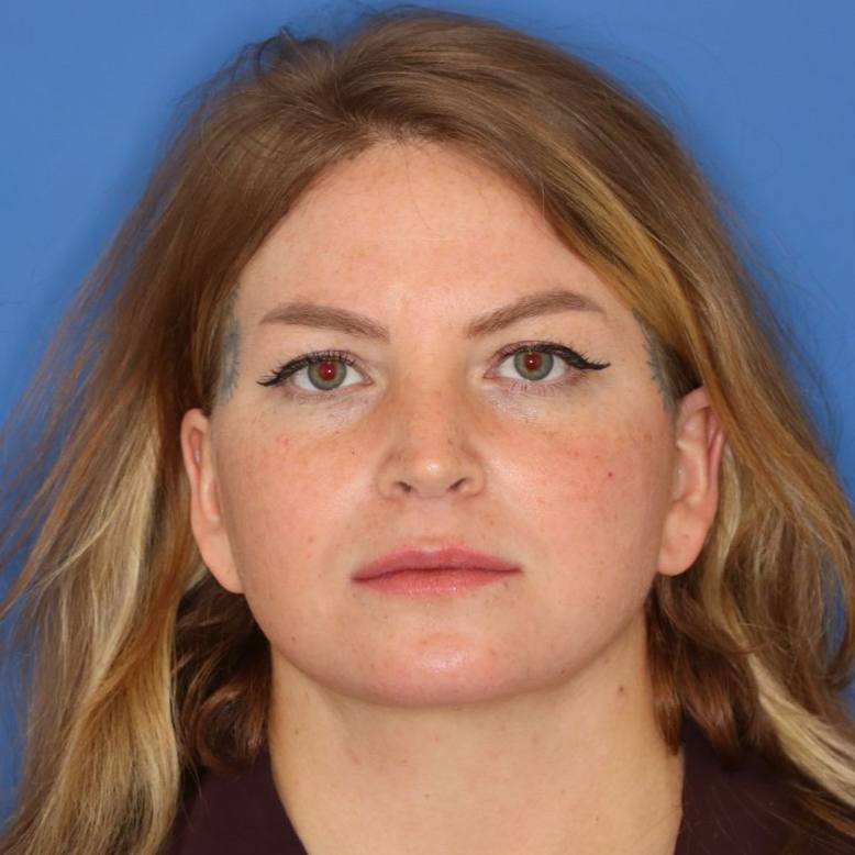 Woman posing in front of a blue wall posing for an after surgery photo