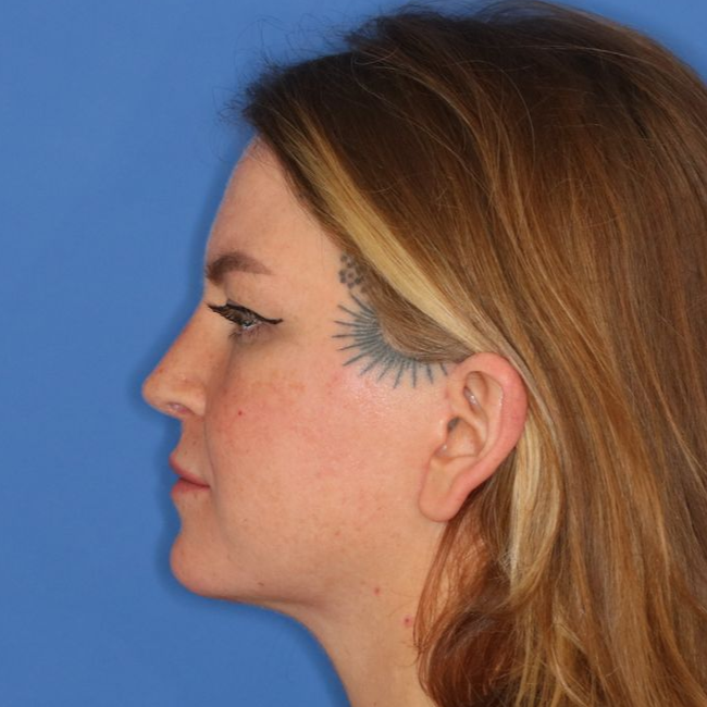 Side profile of a woman after receiving surgery