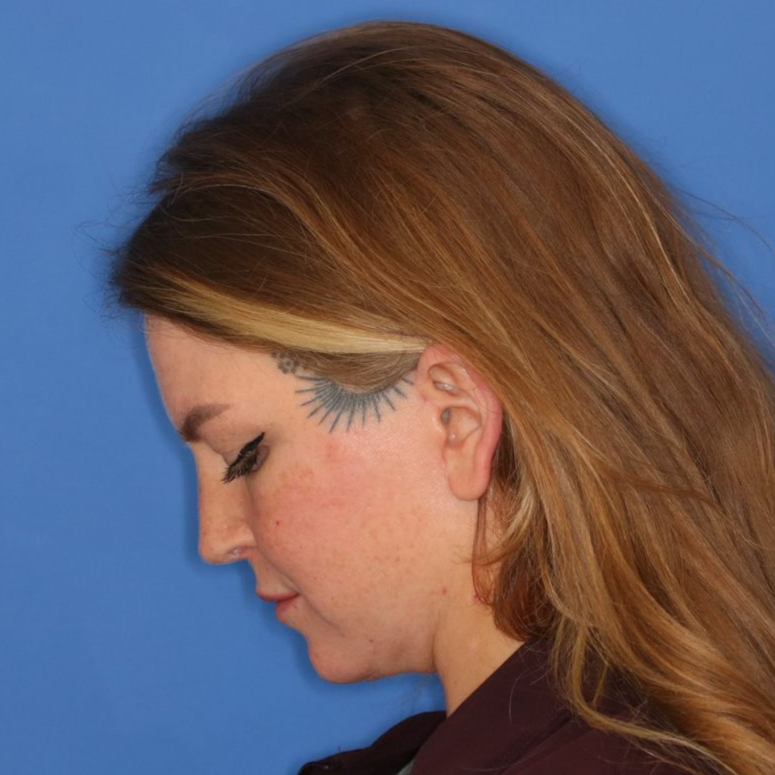 A female patient posing to the left for an after photo of a rhinoplasty surgery