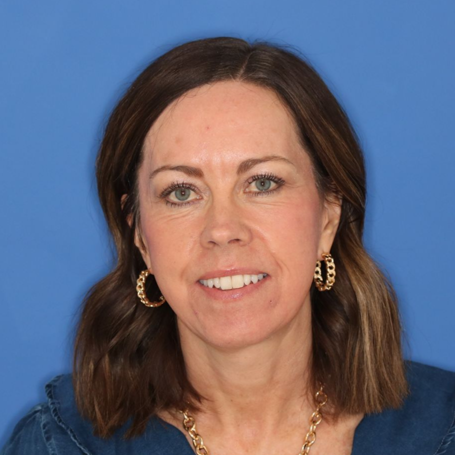 Woman poses in front of a blue background after receiving CO2 laser treatment
