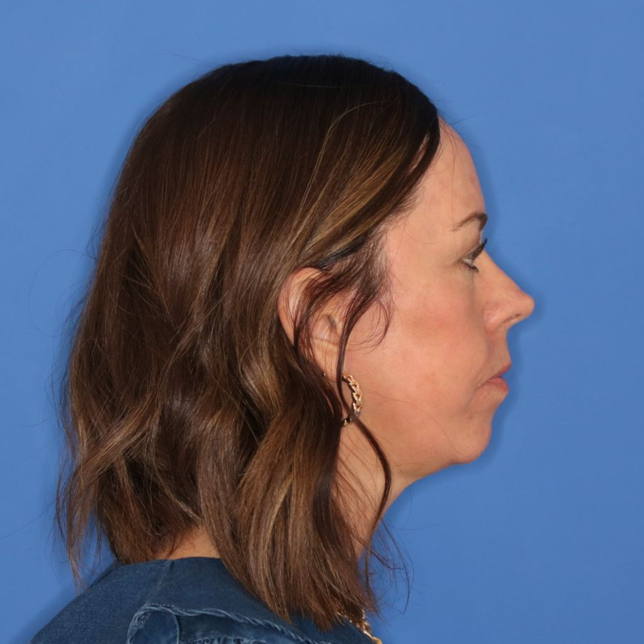 Woman facing to the right in front of a blue background after a facelift
