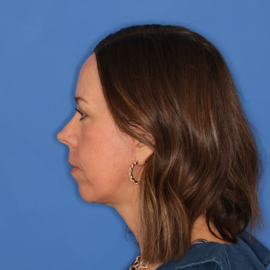 Woman facing to the left posing for an after facelift photo