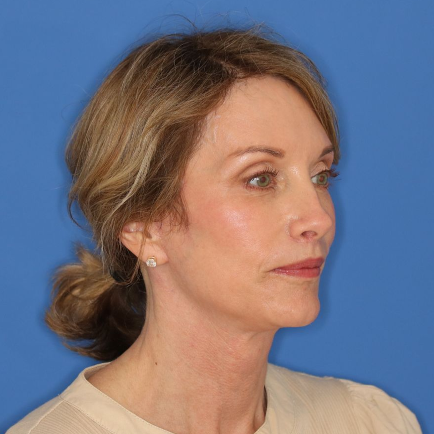 55 year old female underwent deep plane face and neck lift posing on a blue background