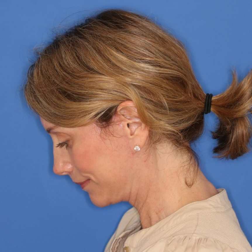 55 year old female underwent deep plane face and neck lift posing for a after photo on a blue background