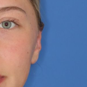 Close up of a 17 year old's ear after an otoplasty
