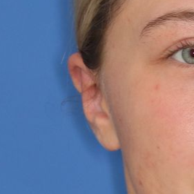 17 year old facing the camera after receiving an otoplasty