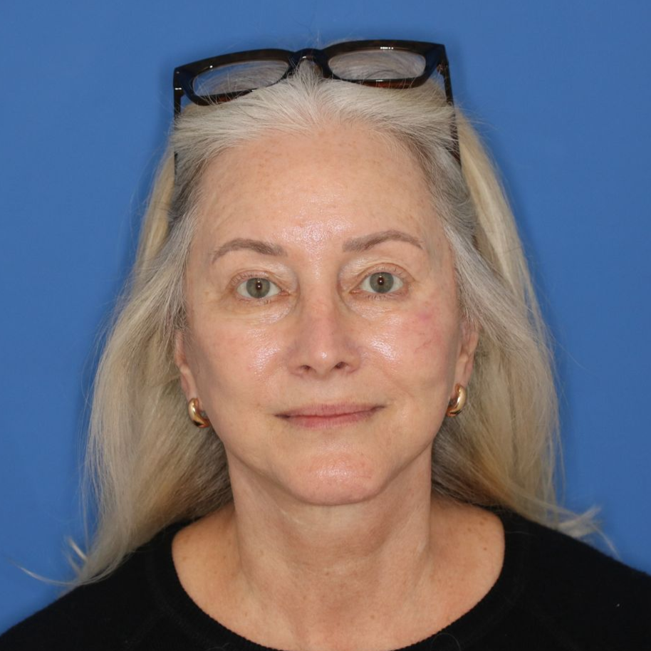 Woman looking toward the camera posing for an after facelift photo