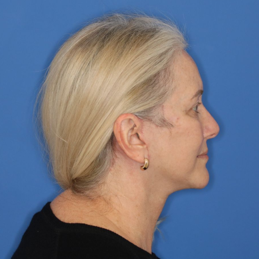 Woman facing to the right posing for a photo after receiving a facelift