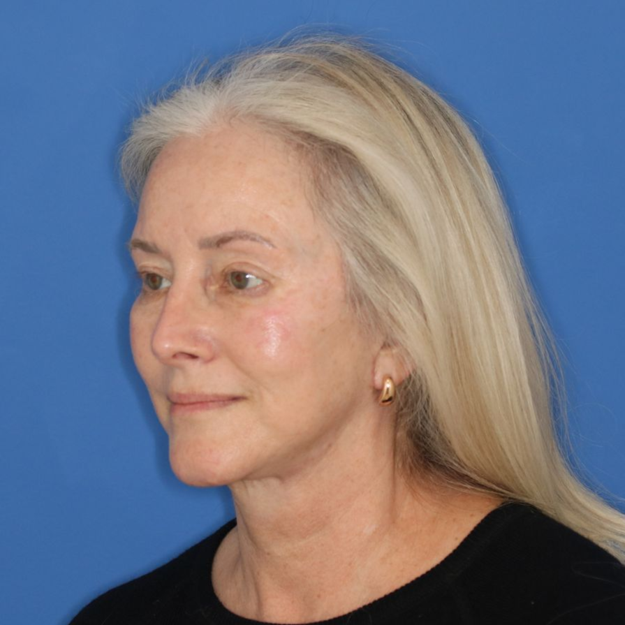 Woman facing to the left posing for an after facelift picture